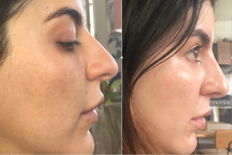 Discover the Magic of Pure Hydroquinone 4%: Before and After Results
